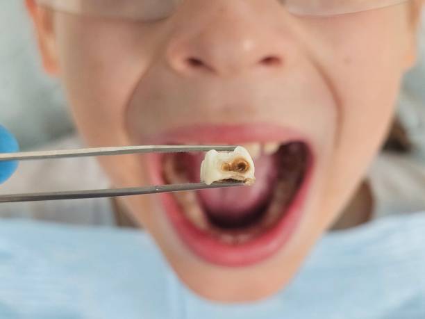Best Emergency Treatment for Dental Infections or Abscesses in Montrose, VA